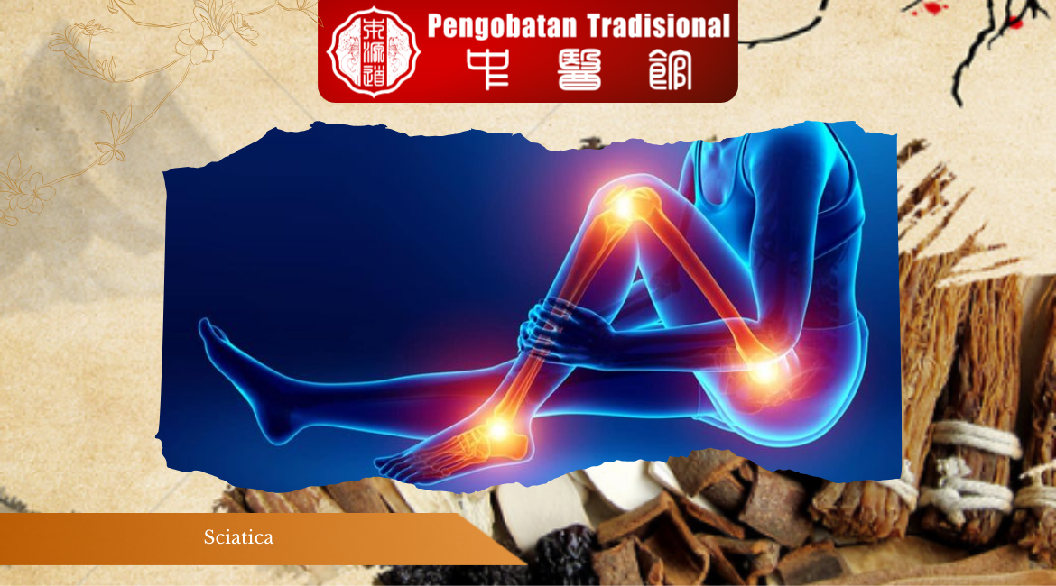 Sciatica Mengganggu? Kenali Gejalanya dan Temukan Solusi Tepat