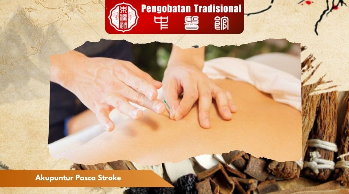 Akupuntur Pasca Stroke: Terapi Alternatif untuk Pemulihan